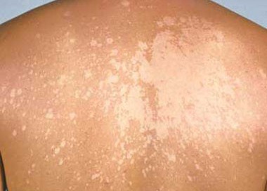 pitiriasis_versicolor-2-e1442819630495